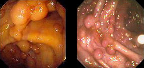 Fotografia registada por método endoscópico de um intestino com pólipos característicos de uma patologia de Polipose adenomatosa familiar