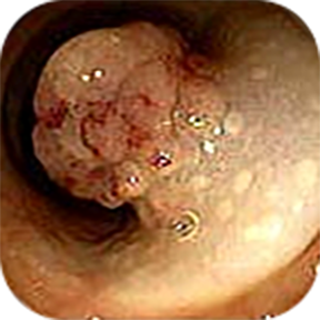 Imagem 1 Pólipo pediculado do intestino grosso