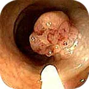 Imagem 2 Ansa diatérmica para remoção do pólipo (polipectomia endoscópica)