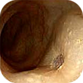 Imagem 5 Escara da polipectomia endoscópica